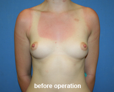 plastic-surgery-breast-augmentation